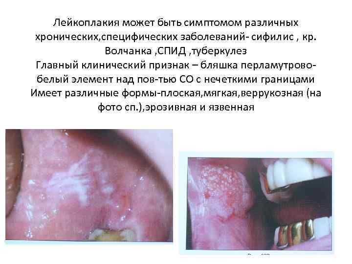 Лейкоплакия может быть симптомом различных хронических, специфических заболеваний- сифилис , кр. Волчанка , СПИД