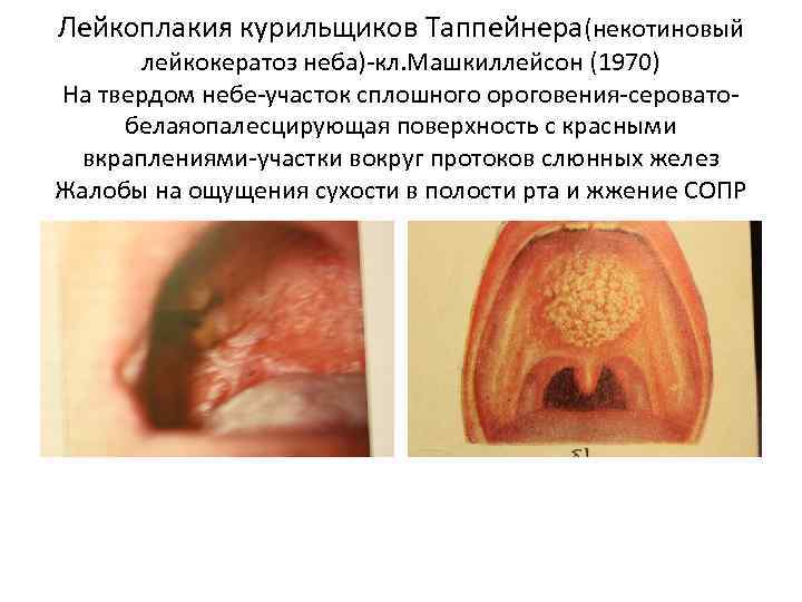 Лейкоплакия курильщиков Таппейнера(некотиновый лейкокератоз неба)-кл. Машкиллейсон (1970) На твердом небе-участок сплошного ороговения-сероватобелаяопалесцирующая поверхность с
