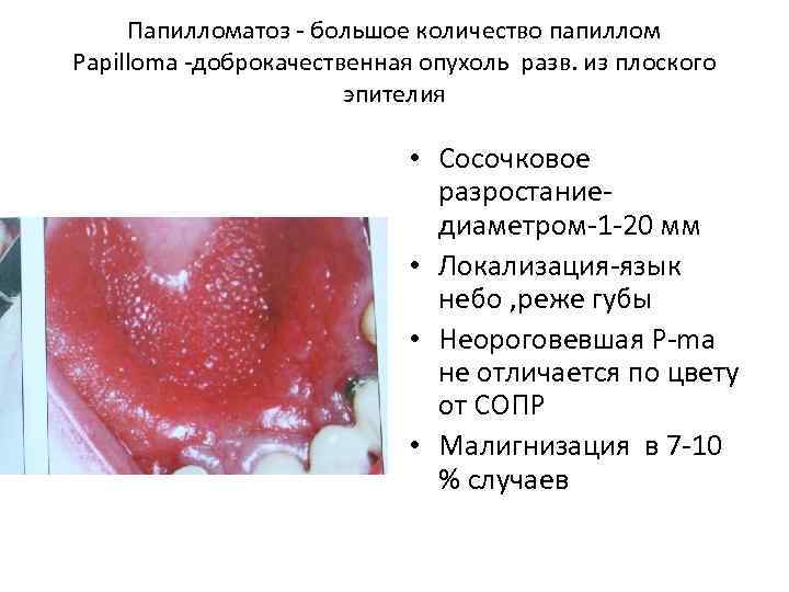 Папилломатоз - большое количество папиллом Papilloma -доброкачественная опухоль разв. из плоского эпителия • Сосочковое