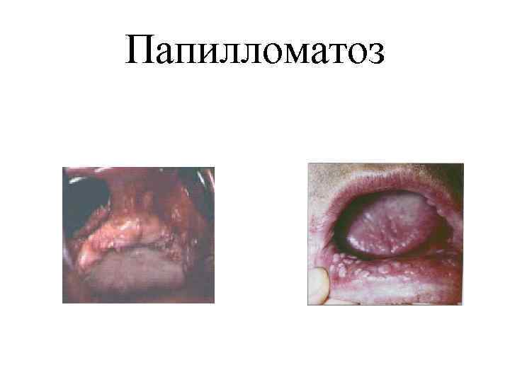 Папилломатоз 