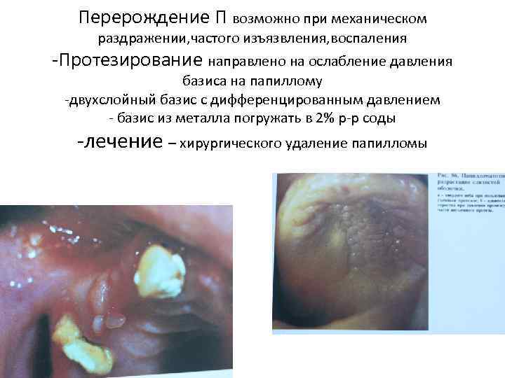 Перерождение П возможно при механическом раздражении, частого изъязвления, воспаления -Протезирование направлено на ослабление давления