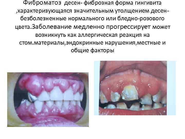 Фиброматоз десен- фиброзная форма гингивита , характеризующаяся значительным утолщением десенбезболезненные нормального или бледно-розового цвета.