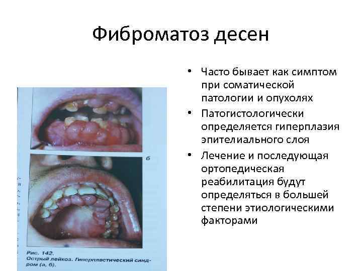Фиброматоз десен • Часто бывает как симптом при соматической патологии и опухолях • Патогистологически