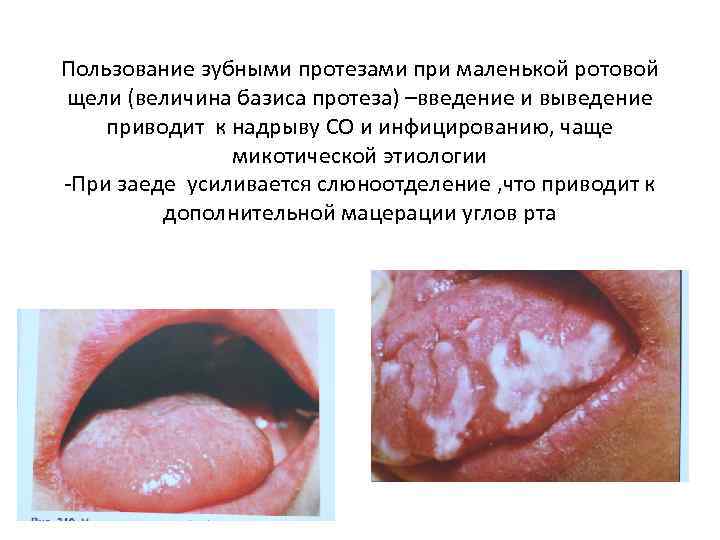 Пользование зубными протезами при маленькой ротовой щели (величина базиса протеза) –введение и выведение приводит