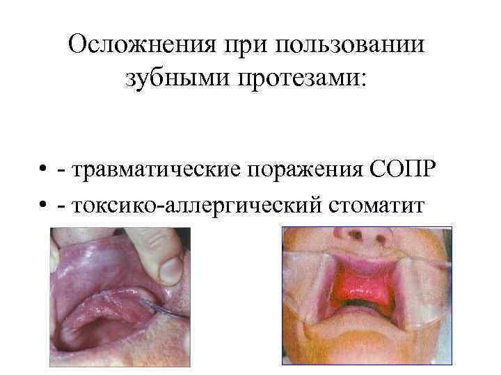 Осложнения при пользовании зубными протезами: • - травматические поражения СОПР • - токсико-аллергический стоматит