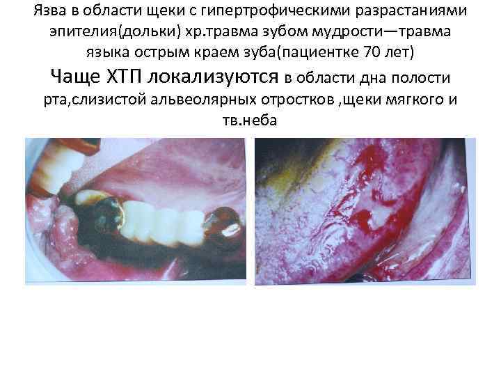 Язва в области щеки с гипертрофическими разрастаниями эпителия(дольки) хр. травма зубом мудрости—травма языка острым