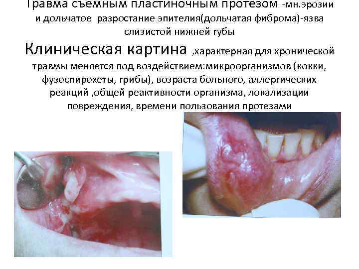 Травма съемным пластиночным протезом -мн. эрозии и дольчатое разростание эпителия(дольчатая фиброма)-язва слизистой нижней губы