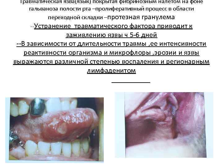 Травматическая язва(язык) покрытая фибринозным налетом на фоне гальваноза полости рта –пролиферативный процесс в области