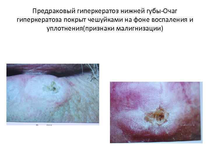 Предраковый гиперкератоз нижней губы-Очаг гиперкератоза покрыт чешуйками на фоне воспаления и уплотнения(признаки малигнизации) 
