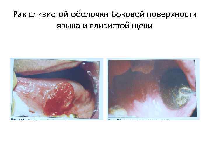 Рак слизистой оболочки боковой поверхности языка и слизистой щеки 