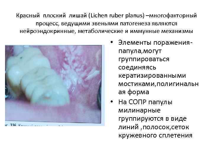 Красный плоский лишай (Lichen ruber planus) –многофакторный процесс, ведущими звеньями патогенеза являются нейроэндокринные, метаболические