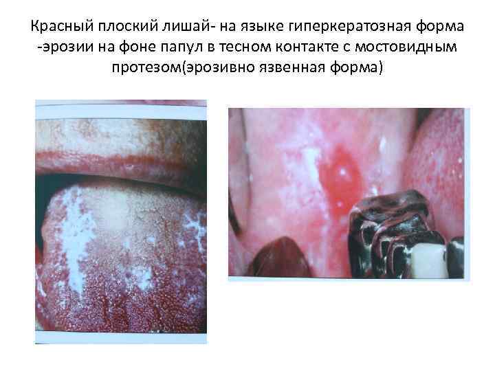 Красный плоский лишай- на языке гиперкератозная форма -эрозии на фоне папул в тесном контакте