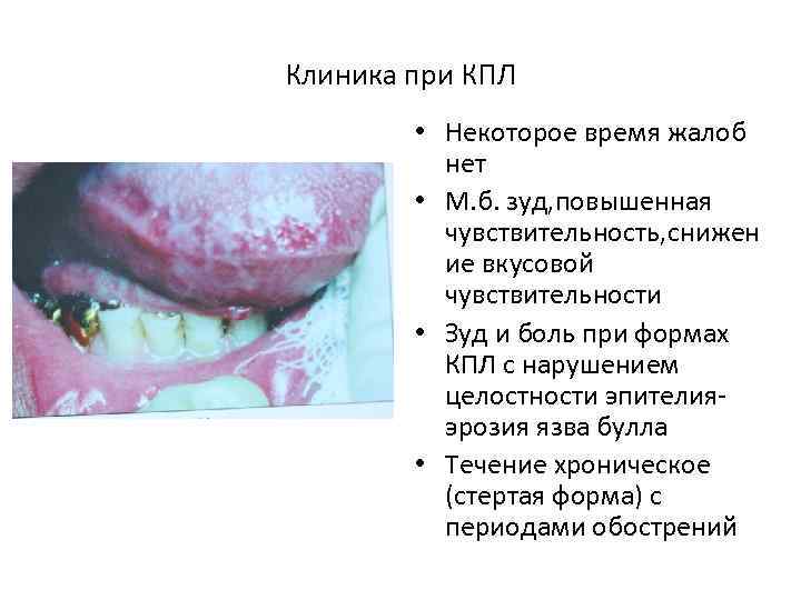 Клиника при КПЛ • Некоторое время жалоб нет • М. б. зуд, повышенная чувствительность,