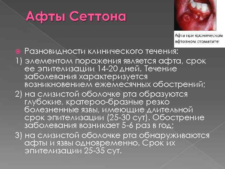 Афты Сеттона Разновидности клинического течения: 1) элементом поражения является афта, срок ее эпителизации 14