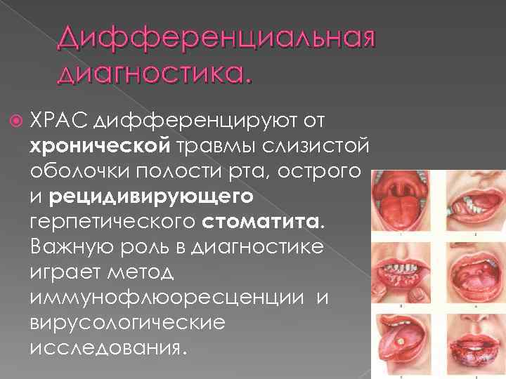 Дифференциальная диагностика. ХРАС дифференцируют от хронической травмы слизистой оболочки полости рта, острого и рецидивирующего