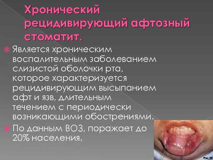Хронический рецидивирующий афтозный стоматит. Является хроническим воспалительным заболеванием слизистой оболочки рта, которое характеризуется рецидивирующим