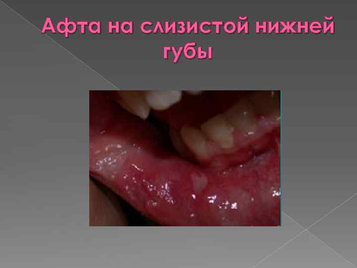 Афта на слизистой нижней губы 