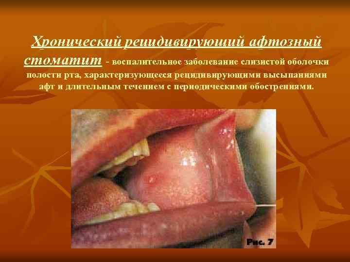 Хронический рецидивирующий афтозный стоматит - воспалительное заболевание слизистой оболочки полости рта, характеризующееся рецидивирующими высыпаниями