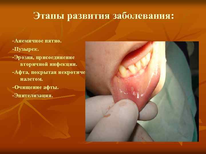 Этапы развития заболевания: -Анемичное пятно. -Пузырек. -Эрозия, присоединение вторичной инфекции. -Афта, покрытая некротическим налетом.