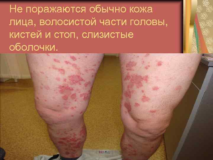 Не поражаются обычно кожа лица, волосистой части головы, кистей и стоп, слизистые оболочки. 