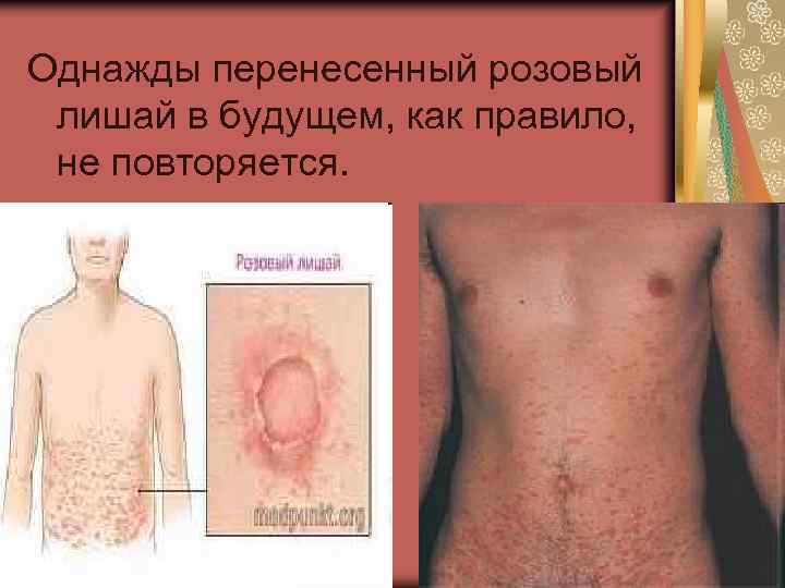 Однажды перенесенный розовый лишай в будущем, как правило, не повторяется. 