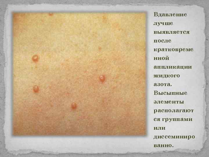 Вдавление лучше выявляется после кратковреме нной аппликации жидкого азота. Высыпные элементы располагают ся группами