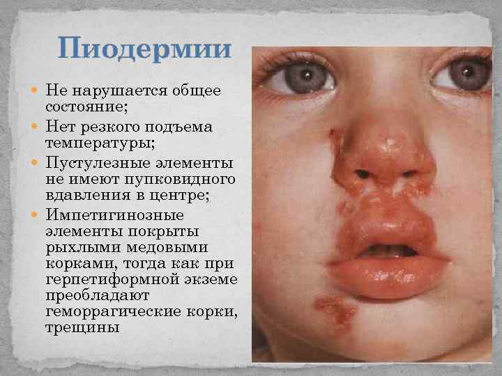 Пиодермии Не нарушается общее состояние; Нет резкого подъема температуры; Пустулезные элементы не имеют пупковидного