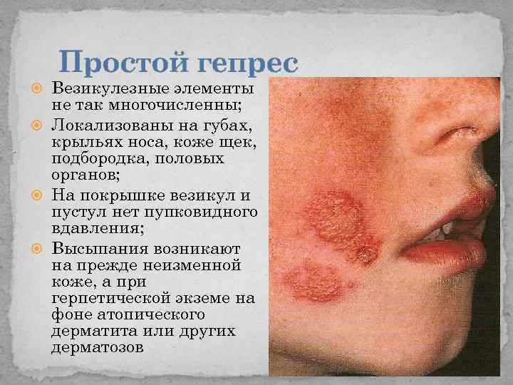 Простой гепрес Везикулезные элементы не так многочисленны; Локализованы на губах, крыльях носа, коже щек,
