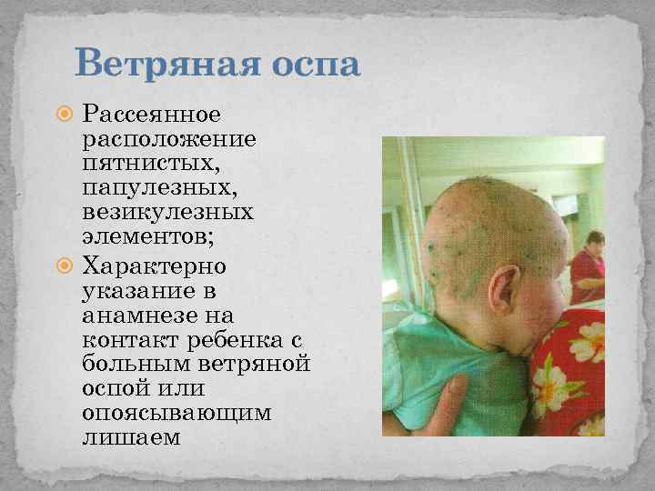 Ветряная оспа Рассеянное расположение пятнистых, папулезных, везикулезных элементов; Характерно указание в анамнезе на контакт