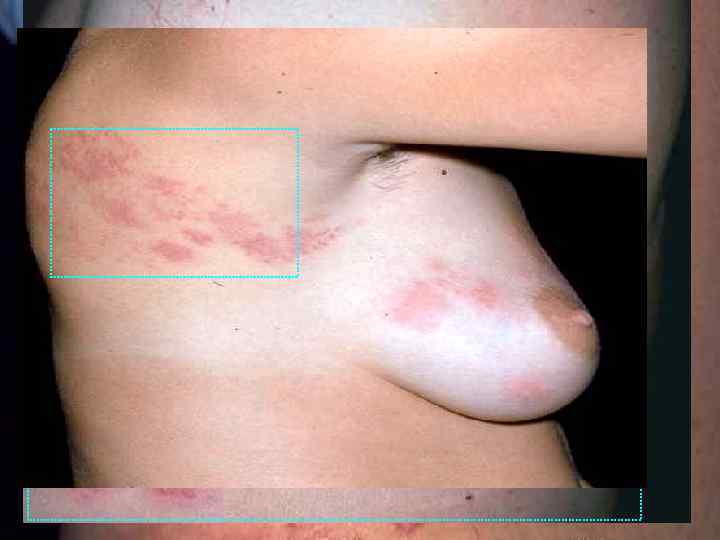 Клинические формы : - абортивная; - геморрагическая; - буллезная; - гангренозная; - генерализованная; -