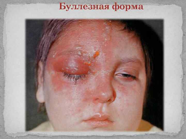 Буллезная форма 