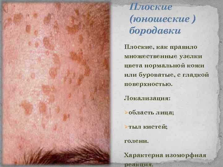 Плоские (юношеские ) бородавки Плоские, как правило множественные узелки цвета нормальной кожи или буроватые,