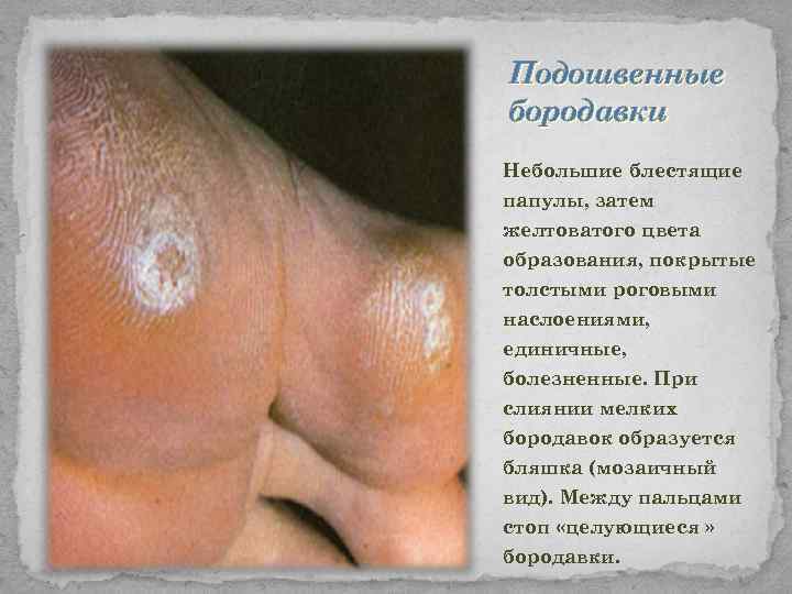 Подошвенные бородавки Небольшие блестящие папулы, затем желтоватого цвета образования, покрытые толстыми роговыми наслоениями, единичные,