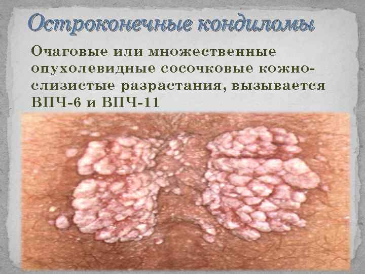 Остроконечные кондиломы Очаговые или множественные опухолевидные сосочковые кожнослизистые разрастания, вызывается ВПЧ-6 и ВПЧ-11 