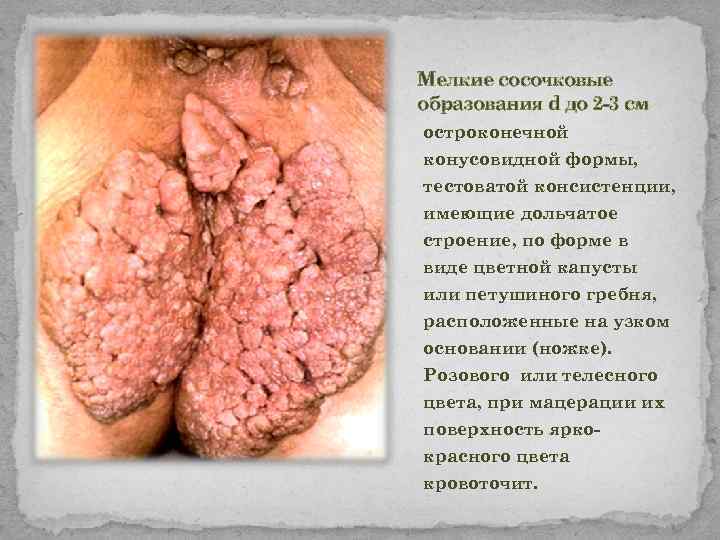 Мелкие сосочковые образования d до 2 -3 см остроконечной конусовидной формы, тестоватой консистенции, имеющие
