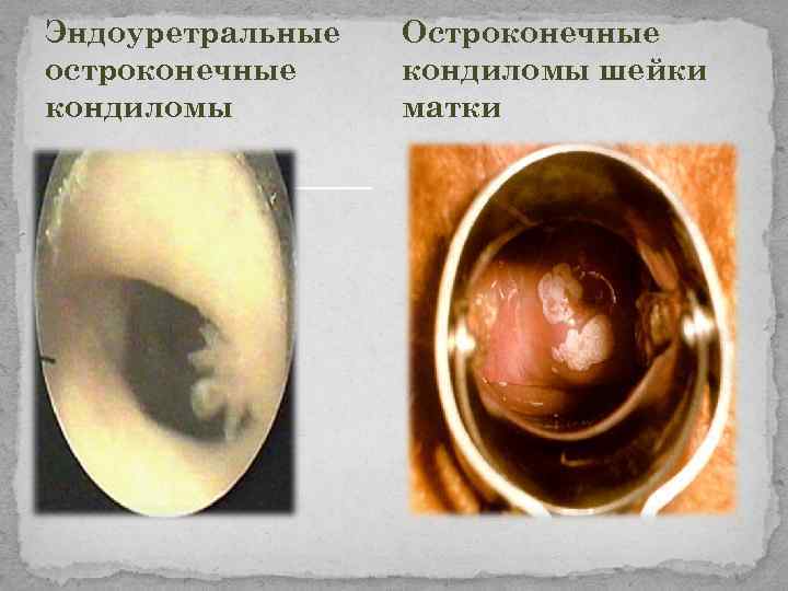Эндоуретральные остроконечные кондиломы Остроконечные кондиломы шейки матки 