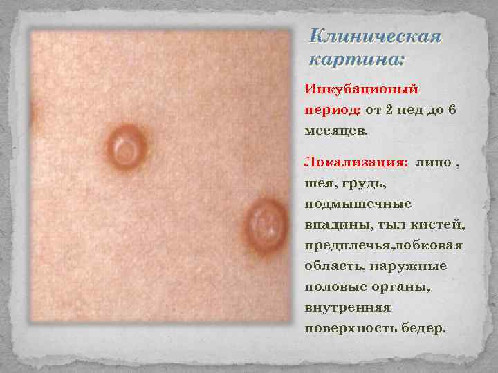 Клиническая картина: Инкубационый период: от 2 нед до 6 месяцев. Локализация: лицо , шея,