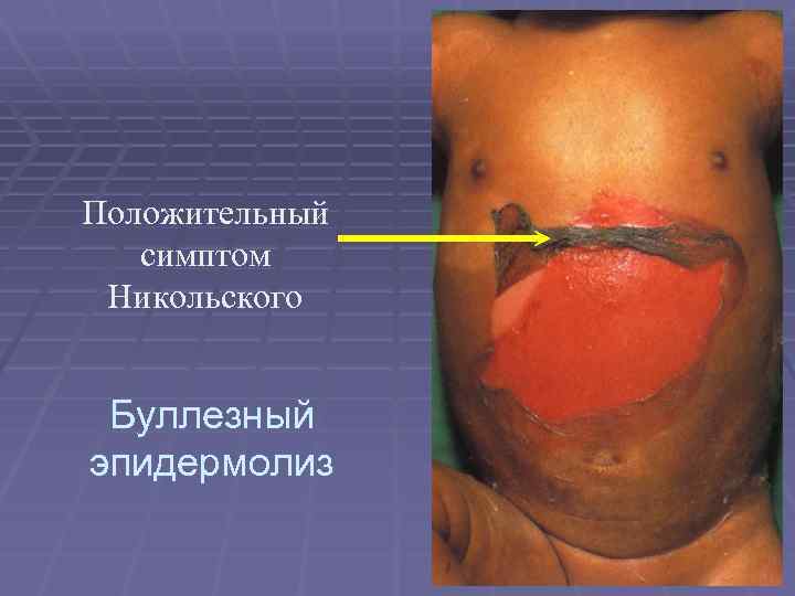 Положительный симптом Никольского Буллезный эпидермолиз 