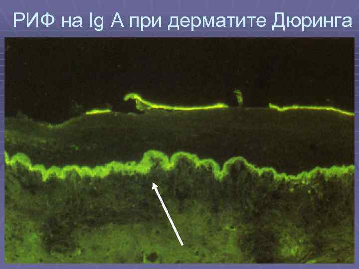 РИФ на Ig A при дерматите Дюринга 