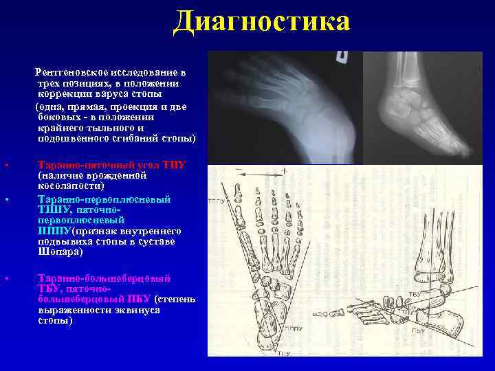 Диагностика Рентгеновское исследование в трех позициях, в положении коррекции варуса стопы (одна, прямая, проекция