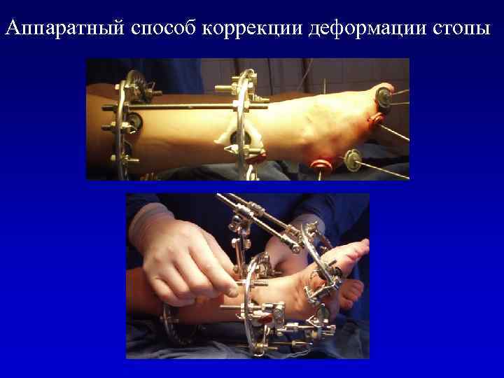 Аппаратный способ коррекции деформации стопы 