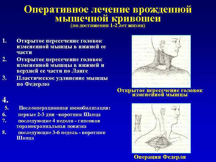 Оперативное лечение врожденной мышечной кривошеи (по достижении 1 -2 лет жизни) 1. 2. 3.