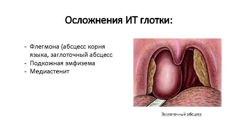 Осложнения ИТ глотки: - Флегмона (абсцесс корня языка, заглоточный абсцесс - Подкожная эмфизема -