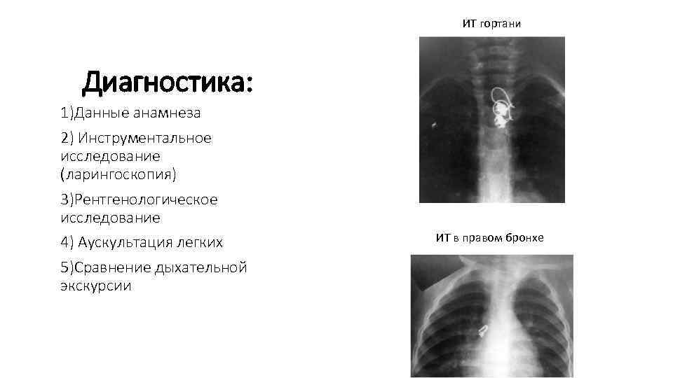 ИТ гортани Диагностика: 1)Данные анамнеза 2) Инструментальное исследование (ларингоскопия) 3)Рентгенологическое исследование 4) Аускультация легких