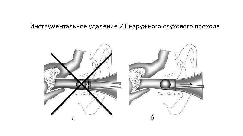 Инструментальное удаление ИТ наружного слухового прохода 