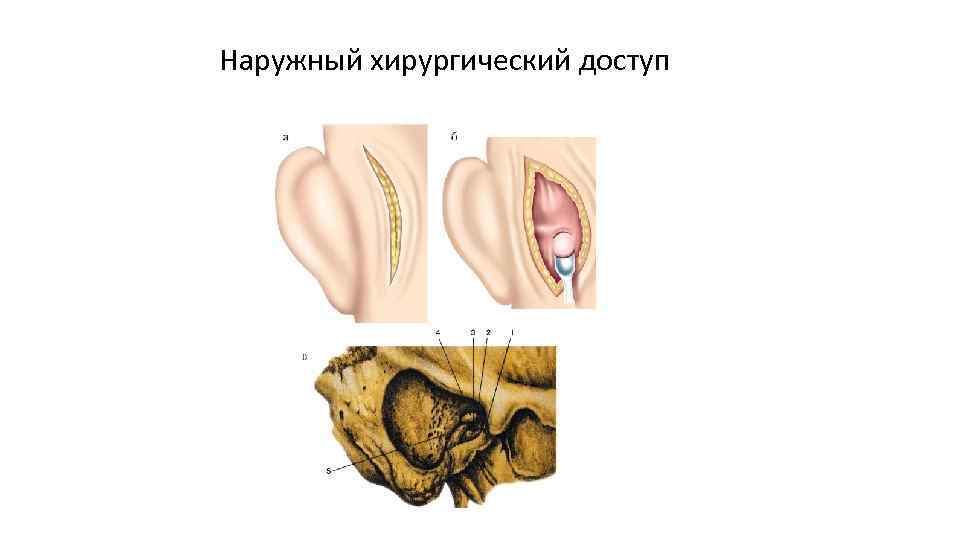 Наружный хирургический доступ 