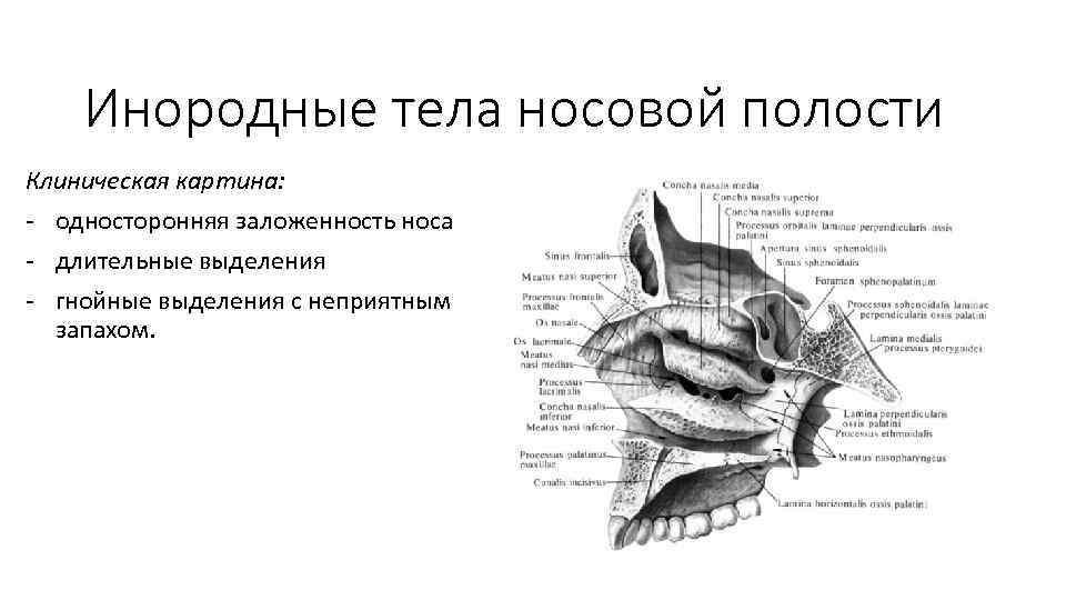 Инородные тела носовой полости Клиническая картина: - односторонняя заложенность носа - длительные выделения -