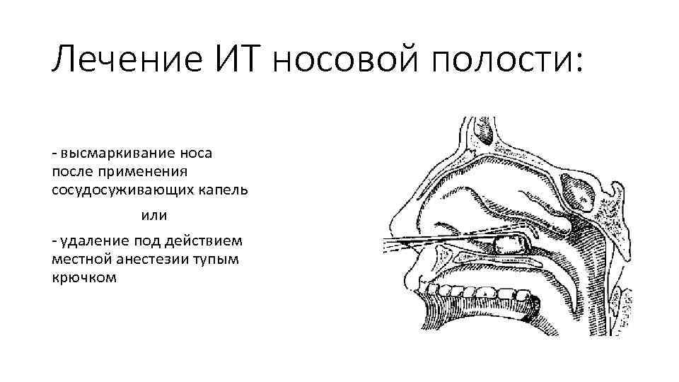 Лечение ИТ носовой полости: - высмаркивание носа после применения сосудосуживающих капель или - удаление