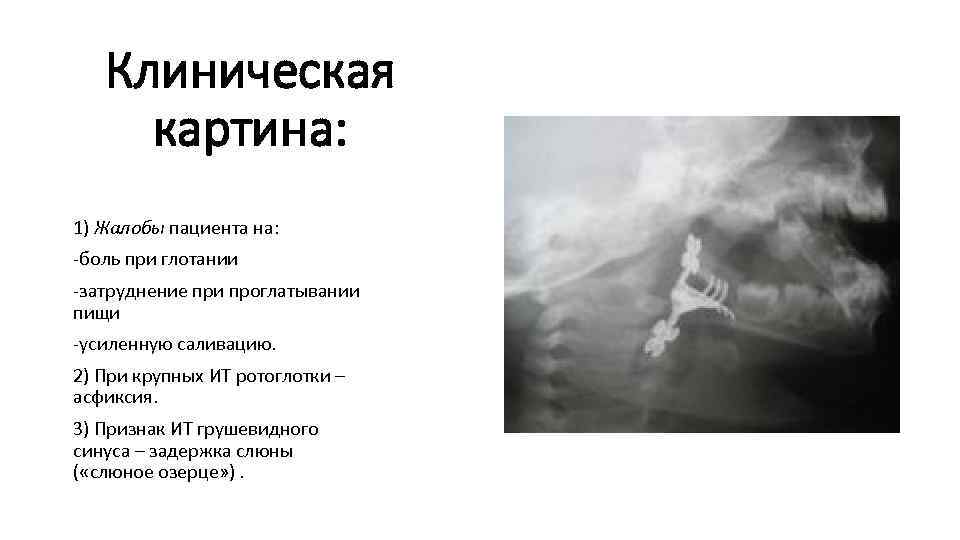 Клиническая картина: 1) Жалобы пациента на: -боль при глотании -затруднение при проглатывании пищи -усиленную