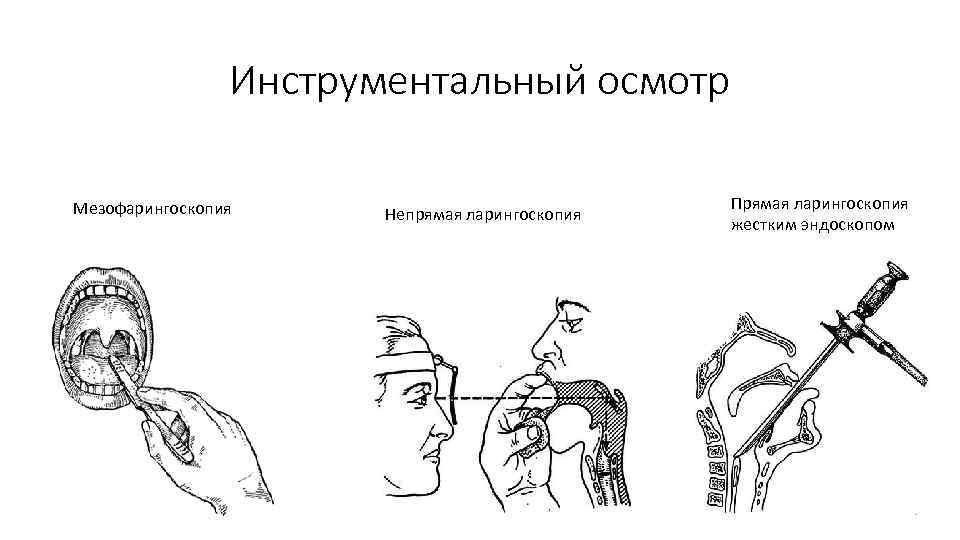 Инструментальный осмотр Мезофарингоскопия Непрямая ларингоскопия Прямая ларингоскопия жестким эндоскопом 